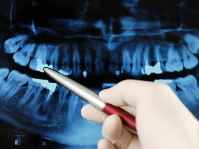 Digital dental X-ray imaging