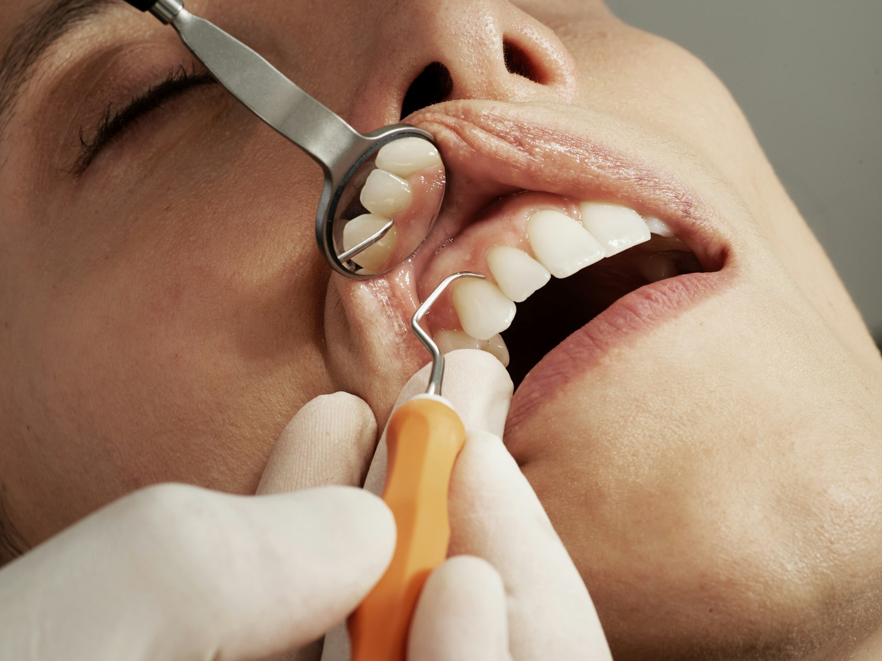 Sedation dentistry at Gentle Dental Smile – anxiety-free dental care in Hanover Park IL