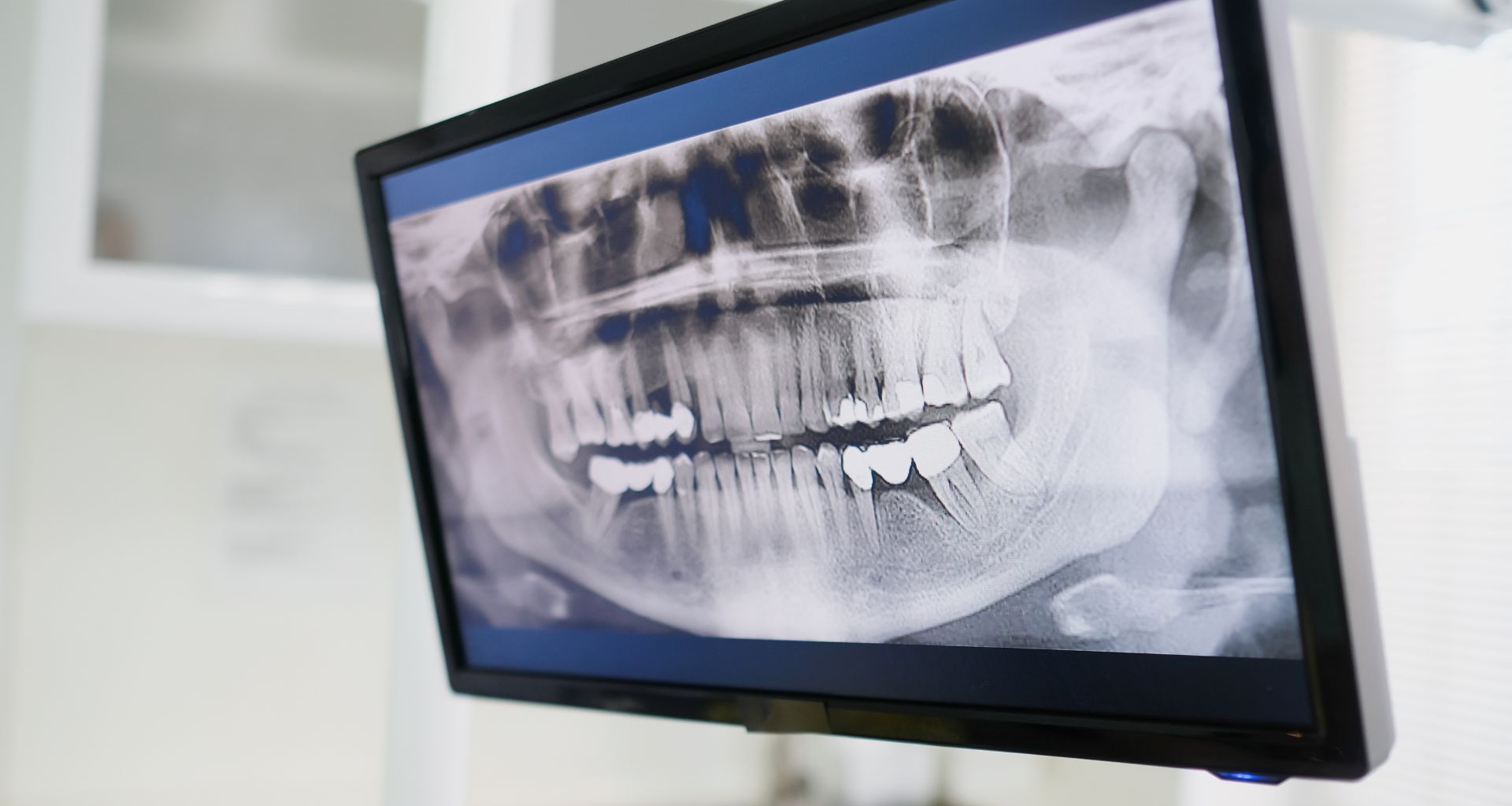Digital X-rays and 3D CBCT dental imaging at Gentle Dental Smile – advanced diagnostic scanning in Hanover Park IL